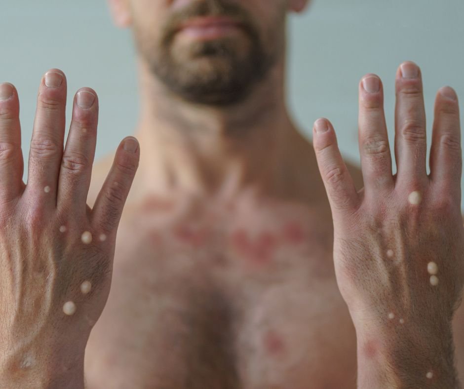 Mpox global health emergency